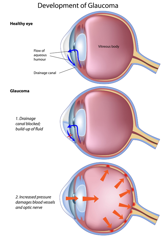 development-of-glaucoma | Ophthalmic Consultants