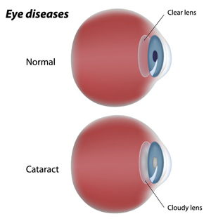 Cataract-Image-1
