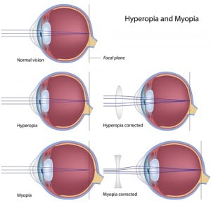 Common Eye Conditions Image 1 Hyperopia Myopia | Ophthalmic Consultants