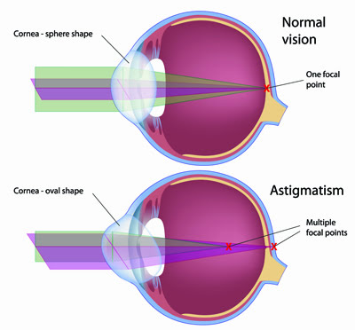 blood cell types | Ophthalmic Consultants