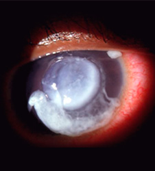 Pseudomonas eye infection. Image courtesy of Federal Drug Administration