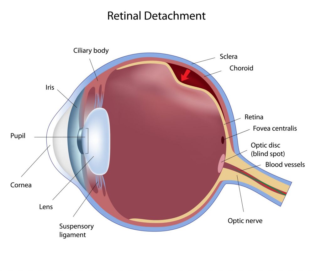 detached retina after cataract surgery