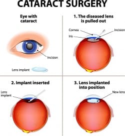 Cataract Surgery Overview | Ophthalmic Consultants, NY