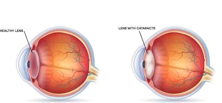 Top Causes of Eye Problems