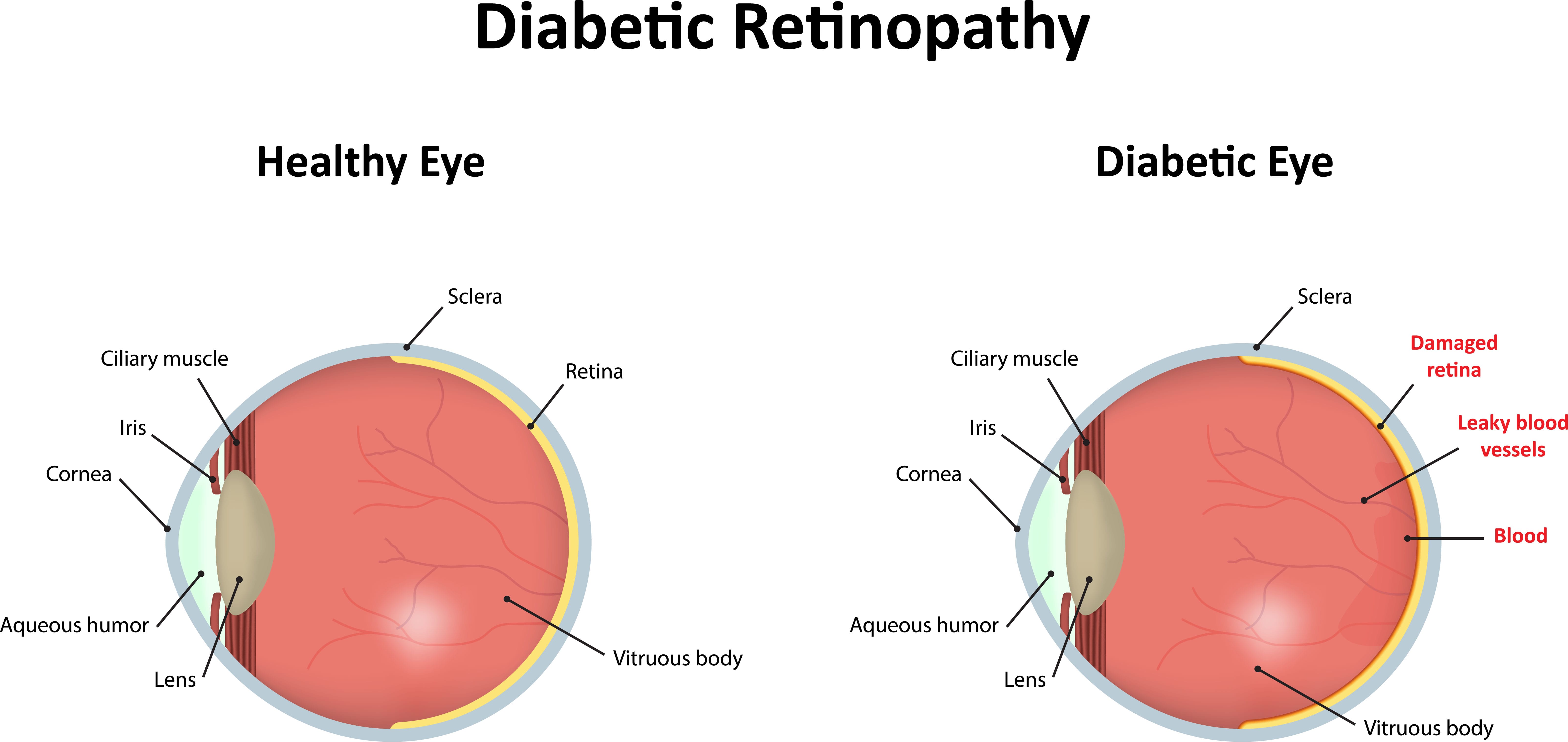 Diabetic Retinopathy Ophthalmic Consultants