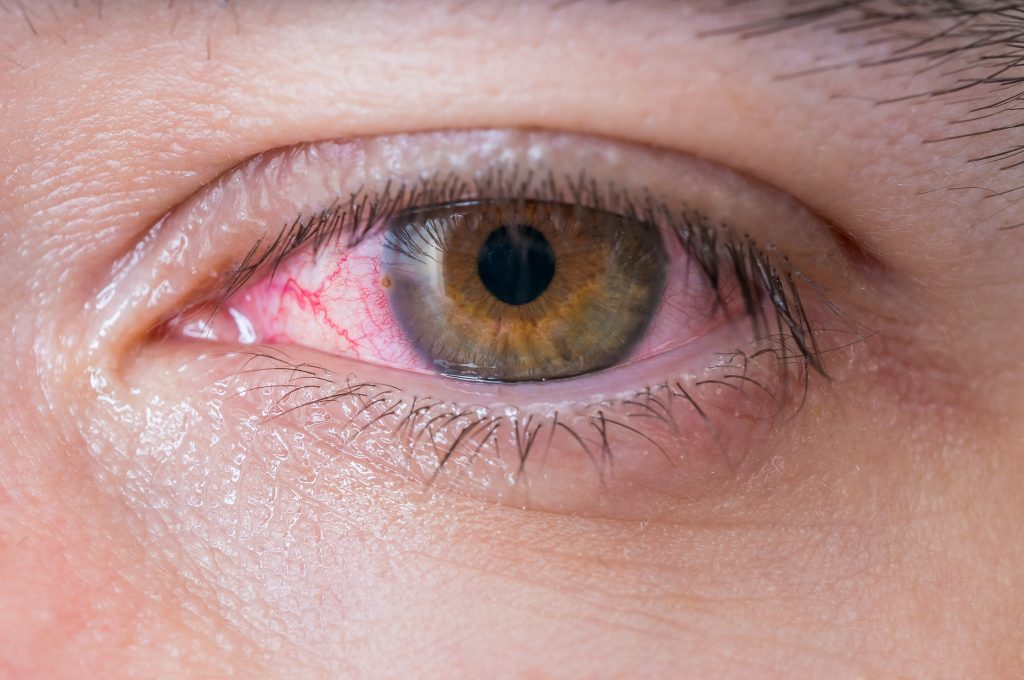 Dry Eye Or Seasonally Allergies: Here's What You Need To Know ...