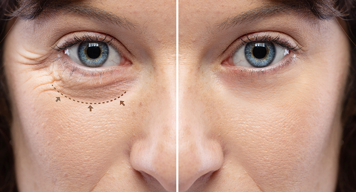 Upper/Lower eyelid aesthetic treatment (Blepharoplasty) Ophthalmic