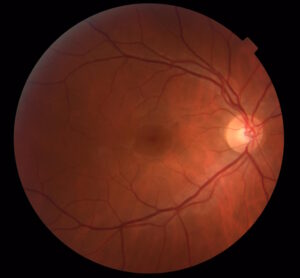retinal diseases close-up of retina 